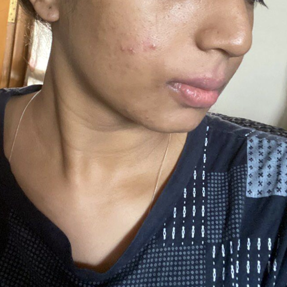 ab-1-after